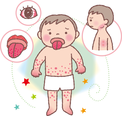 発疹や充血が現れた子どものイラスト